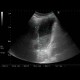 Primary sclerosing cholangoitis, sludge: US - Ultrasound